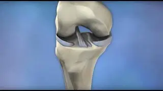 ACL Injury Prevention - Mayo Clinic