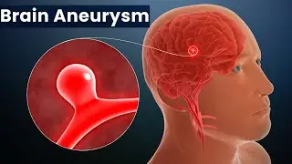 Brain Aneurysm, Causes, Signs and Symptoms, Diagnosis and Treatment.