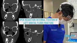 Left Orbital Floor Fracture | Dr. Shaun Young