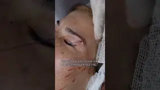 “Лисий взгляд» за час! Ждем вас в  нашей клинике @elevans.clinic