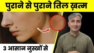 तिल और मस्से बिना लेज़र या सर्जरी जड़ से ख़त्म करें | तिल और मस्से का इलाज | Moles & Warts Treatment