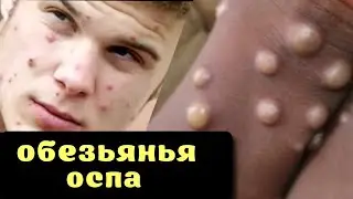 🛑ПРИЗНАКИ И УГРОЗЫ ОБЕЗЬЯНЬЕЙ ОСПЫ