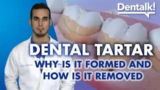 TARTAR from teeth - Causes, prevention and how to REMOVE dental PLAQUE and calculus | Dentalk! ©