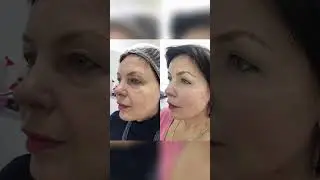 Убираем малярные мешки - омолаживаем зону глаз