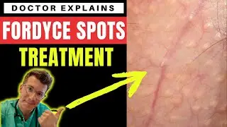 How to treat FORDYCE SPOTS - Doctor O'Donovan explains...