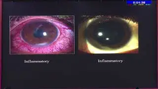 AIOC2020 IC426 T5 Dr Reema Bansal ’’Not sure of infectious or inflammatory!