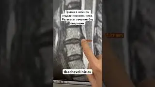 Грыжа в шейном отделе позвоночника. Результат лечения без операции. 