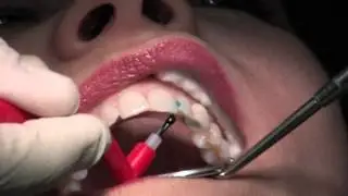 Composite Fillings