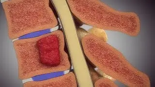 Spine Injury Animation with Hemangioma