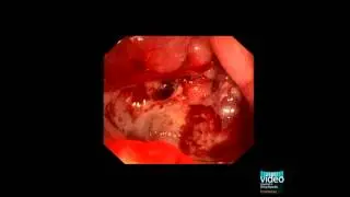 Tumours in the Small Bowel