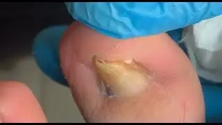 Deep cleaning for naills