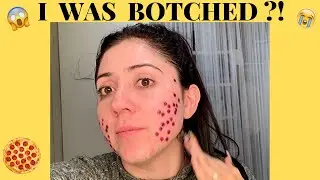 I WAS BOTCHED?! (LASER V-BEAM)