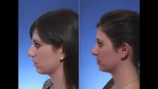 Dr Jacob Steiger Review After Rhinoplasty in Boca Raton