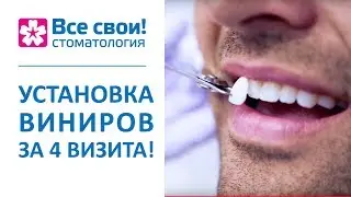 💎  Этапы установки виниров, виды и особенности. Установка виниров этапы. Стоматология Все Свои. 12+