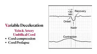 Fetal heart rate tracing | Mnemonics, Concepts & Management | High yield review