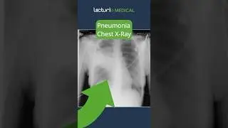 Understanding Lobar Pneumonia 🫁 #MedicalEducation #usmle