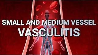 Small and Medium Vessel Vasculitis - CRASH! Medical Review Series