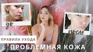 КАК УХАЖИВАТЬ ЗА ПРОБЛЕМНОЙ кожей? Средства от прыщей. МОЙ ОПЫТ.