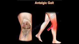 Painful Gait, Antalgic Gait, painful gait.