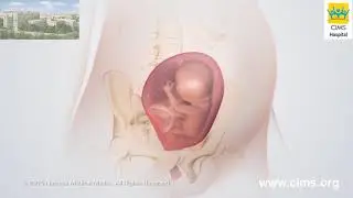 Congenital Diaphragmatic Hernia Repair – CIMS Hospital