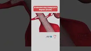 Endovascular Aneurysm Repair 🫀🛠️