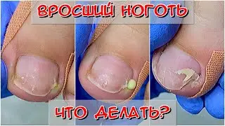 Врос ноготь на ноге /Не правильно стриг ногти /Что делать, если врос ноготь?Тампонада вросшего ногтя