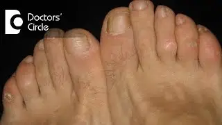 What causes itching, scaly lesions in webs of finger and toes?  - Dr. Sudheendra Udbalker