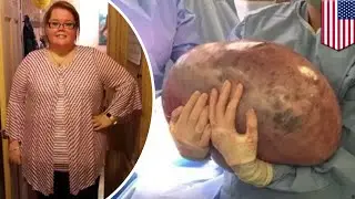 Giant 50 pound cyst removed from Alabama woman's ovary - TomoNews