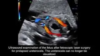 Fetoscopic surgery for fetal prolapsed ureterocele