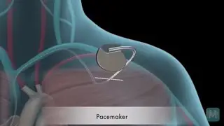 What Is A Pacemaker? | Match Health