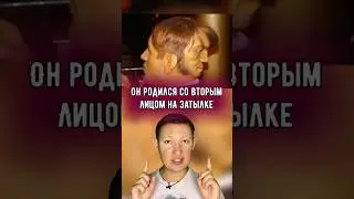 Этот парень родился со вторым лицом на затылке