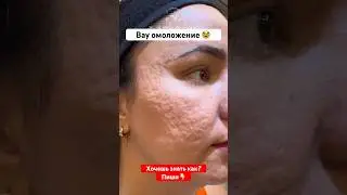 Самый мощный из всех пилингов!альтеревтива операции и шлифовке #омоложение #пилинг #морщины #акне