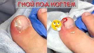 Гной под ногтем 😮 Вросший ноготь на ноге