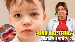 🔸Conjuntivitis BACTERIANA en niños 👶🏻 TRATAMIENTO 2024 ✅