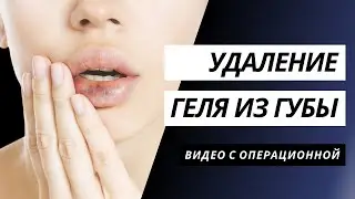 УДАЛЕНИЕ КАПСУЛИРОВАННОГО БИОПОЛИМЕРНОГО ГЕЛЯ ИЗ ВЕРХНЕЙ ГУБЫ | МИГРАЦИЯ ГЕЛЯ | ПЛАСТИКА ГУБ КИЕВ