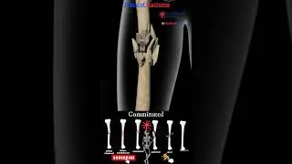 Types of bone fractures 🦴 bone fractures