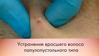 Устранение вросшего волоса папулопустольного типа\Eliminating ingrown hair papulopustulosa type