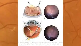 Interview with SriniVas Sadda, Editor-in-Chief of Ryan's Retina, 7th Edition