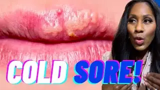 GET RID OF COLD SORES FAST! Plus, Are Cold Sores CONTAGIOUS? What Causes Cold Sores? A Doc Explains