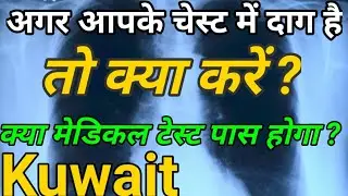 How to Pass Kuwait Medical Test | अगर आपके चेस्ट में दाग हैं तो क्या करें ?