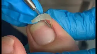 Extreamly long nail trimming