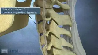 Anterior Subluxation in the Cervical Spine - 3D Animation