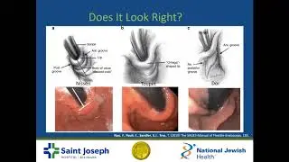 SAGES Foregut Facebook Livestream: Techniques in Hiatal Surgery