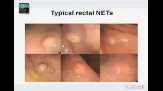 The Morphologic Assessment of Rectal Neuroendocrine Tumors