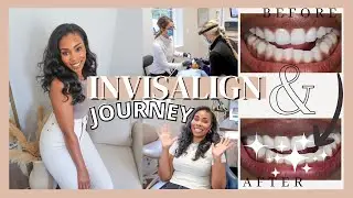 INVISALIGN JOURNEY START TO FINISH | WHAT TO EXPECT WITH INVISALIGN // LoveLexyNicole