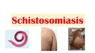 Schistosomiasis | Bilharziasis | Causes, Symptoms and Treatment