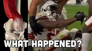 WORST NFL Injury? Doctor Explains Nick Chubb knee dislocation