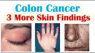 Colon Cancer: 3 Other Weird Symptoms (Found on the Skin)