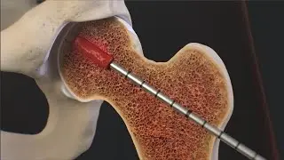 IntraOsseous BioPlasty® (IOBP) Surgical Technique for a Bone Marrow Lesion of the Hip