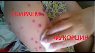 HOW TO CLEAR THE SPOT FROM FUKORCIN AFTER THE VETRYANKA